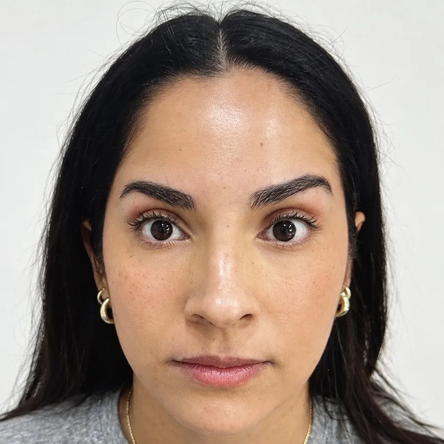 Después: Botox