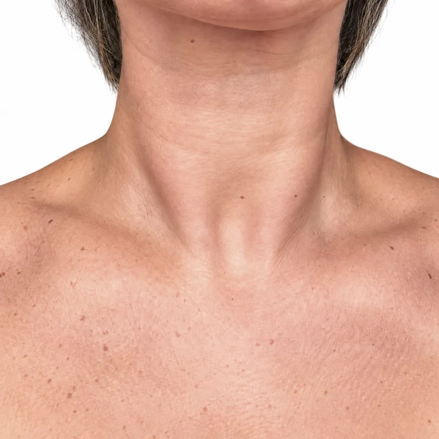 Después: Botox Terapéutico