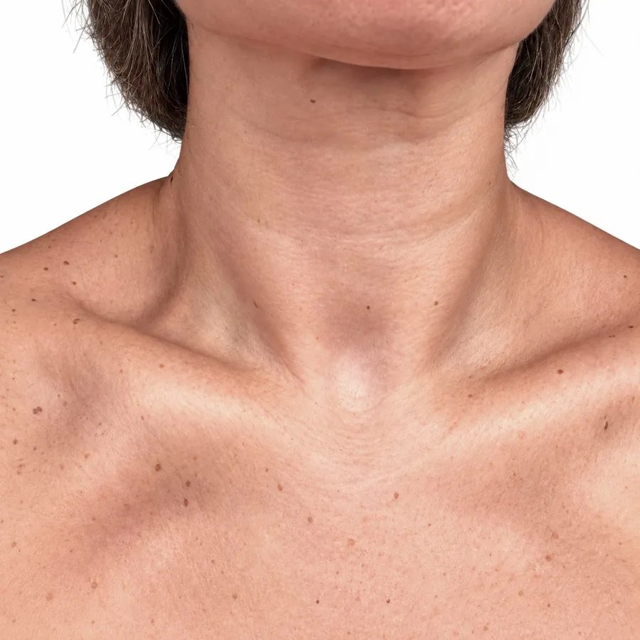 Antes: Botox Terapéutico