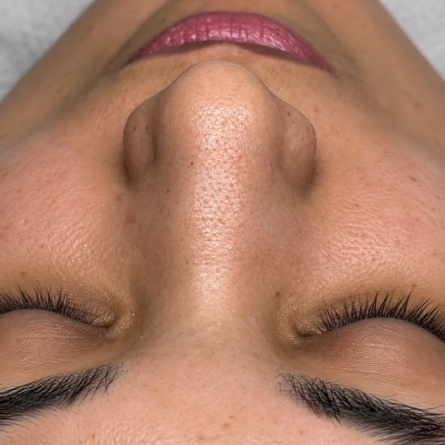 Antes: Facial
