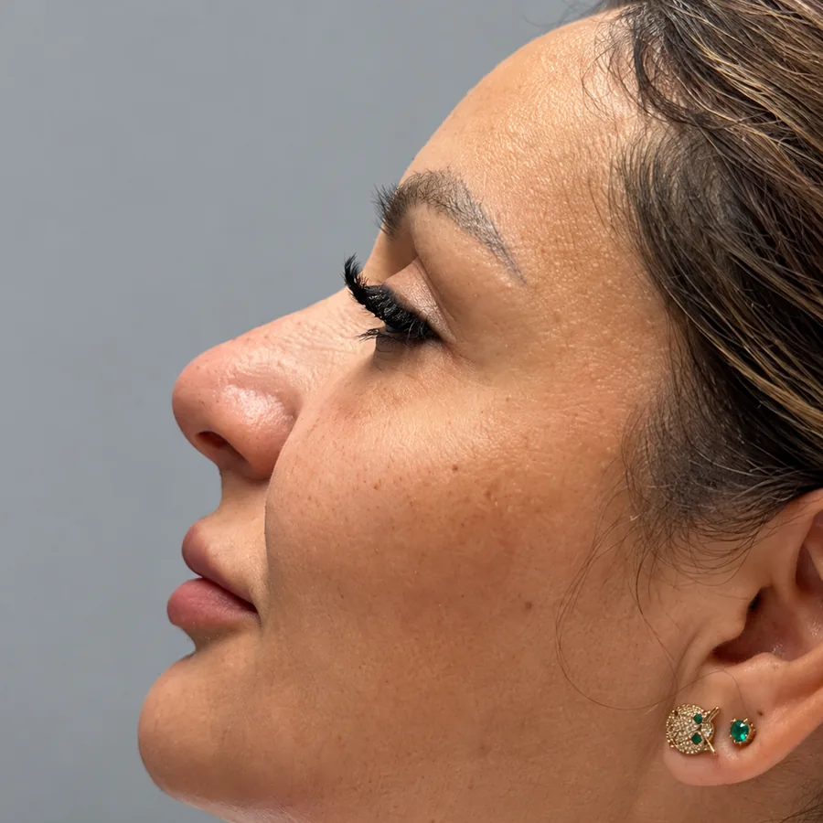 Después: Fillers
