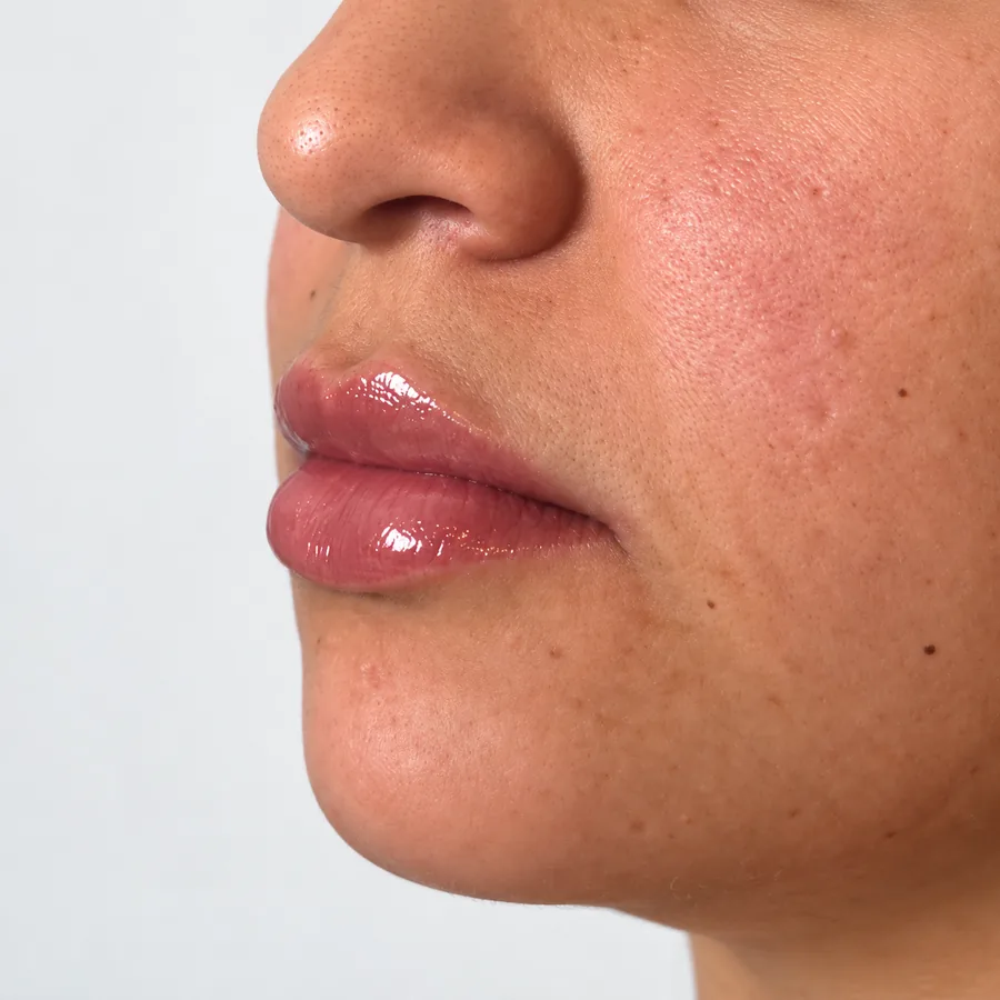 Después: Lip Filler