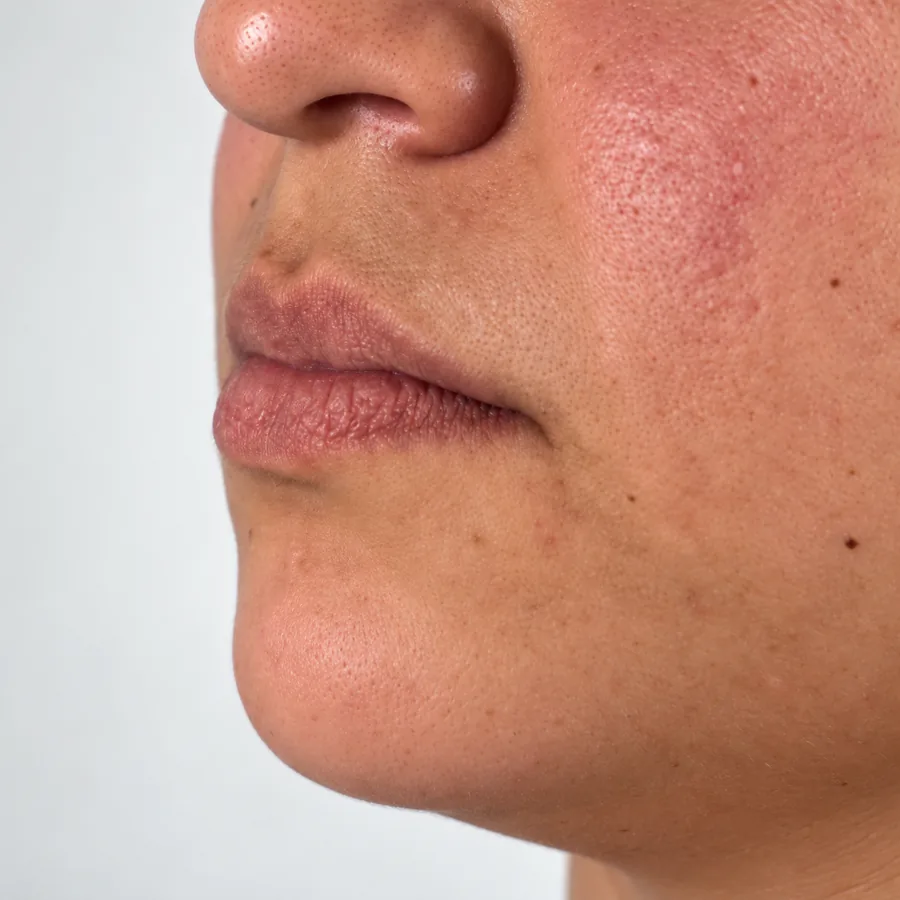 Antes: Lip Filler