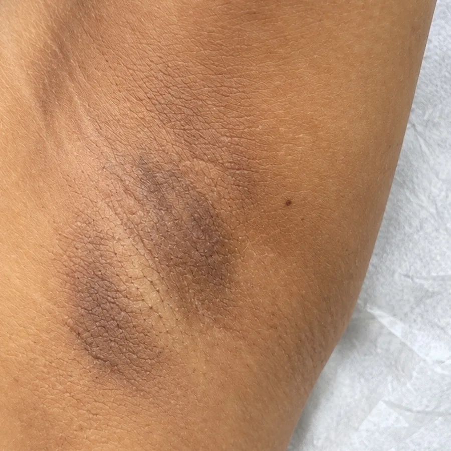 Antes: Peeling Químico